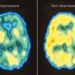 Can A Pet Scan of the Brain Detect Depression?