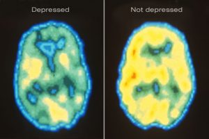 Can A Pet Scan of the Brain Detect Depression?